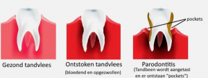 Gezond tandvlees - Ontstoken tandvlees - Parodontitis